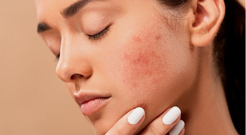 L'aloe vera contre l'acné